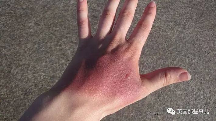 轻微晒伤后,可以用洗脸巾或纸巾蘸醋涂在晒伤的部位,要在晒伤后立即涂